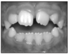 Figure 3. Open Bite