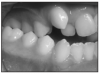 Figure 4. Crossbite (Photo compliments of Dr. Rebecca Poling)