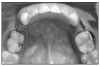 Figure 5. Space Maintainer. (Photo compliments of Dr. Rebecca Poling)