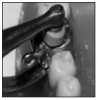 Figure 14. Band Removing Plier (for removing bands and banded appliances)