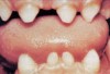 Fig. 1 Anomalies—variations in the number, size, and shape of teeth (www.nohic.nidcr.nih.gov).