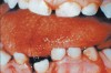 Fig. 4 Oral trauma—occurs more frequently in people with mental retardation, abnormal reflexes, or muscle incoordination (<a href-
